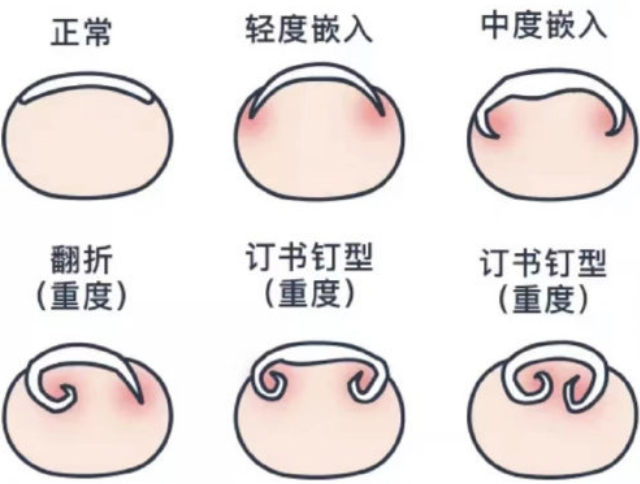 廣西美甲基礎(chǔ)培訓：正確修剪指甲的方法
